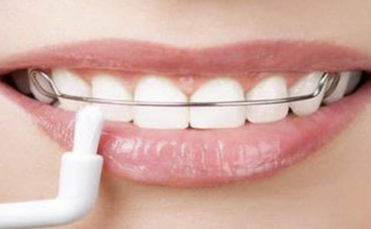 Mengatasi Gigi Renggang dengan Kawat